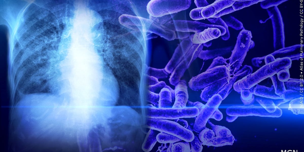Second tuberculosis report involving Pitt County student, investigation underway