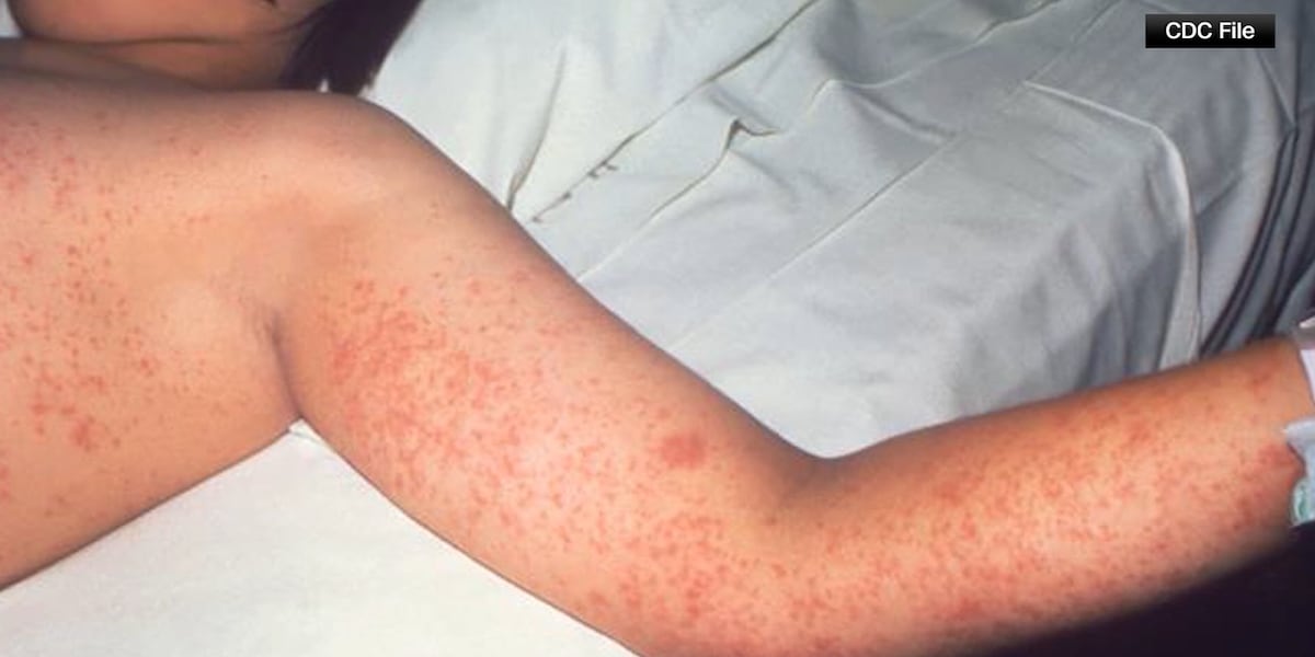 Child measles case confirmed in North Carolina